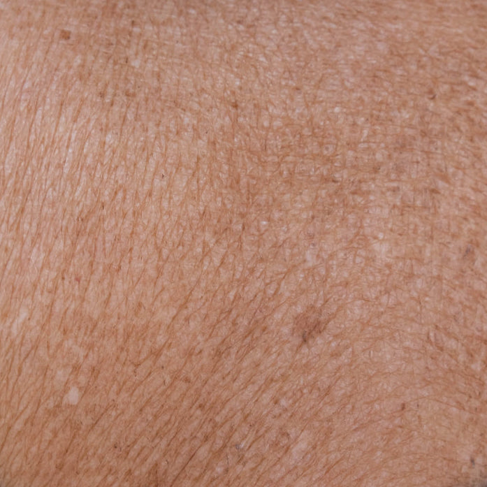 What is skin laxity?