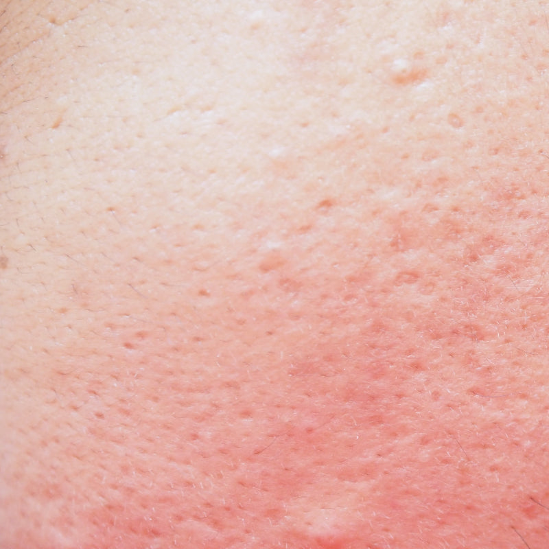 What causes skin redness?