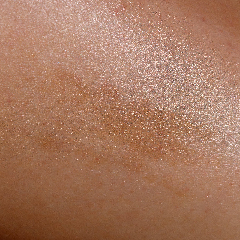 What causes hyperpigmentation?